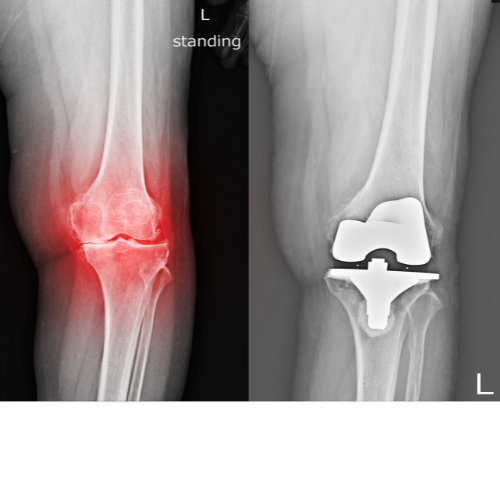 Physical Therapy with Knee and Hip Replacements Yoga Therapy Bar physical therapy, yoga